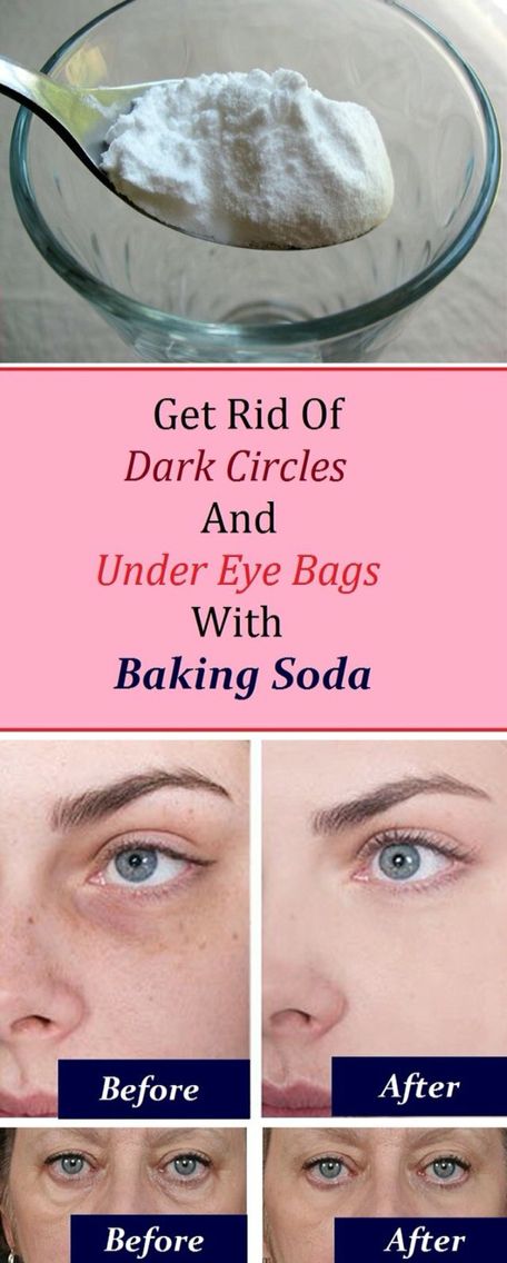 remove dark circles and under eye bags with backing soda